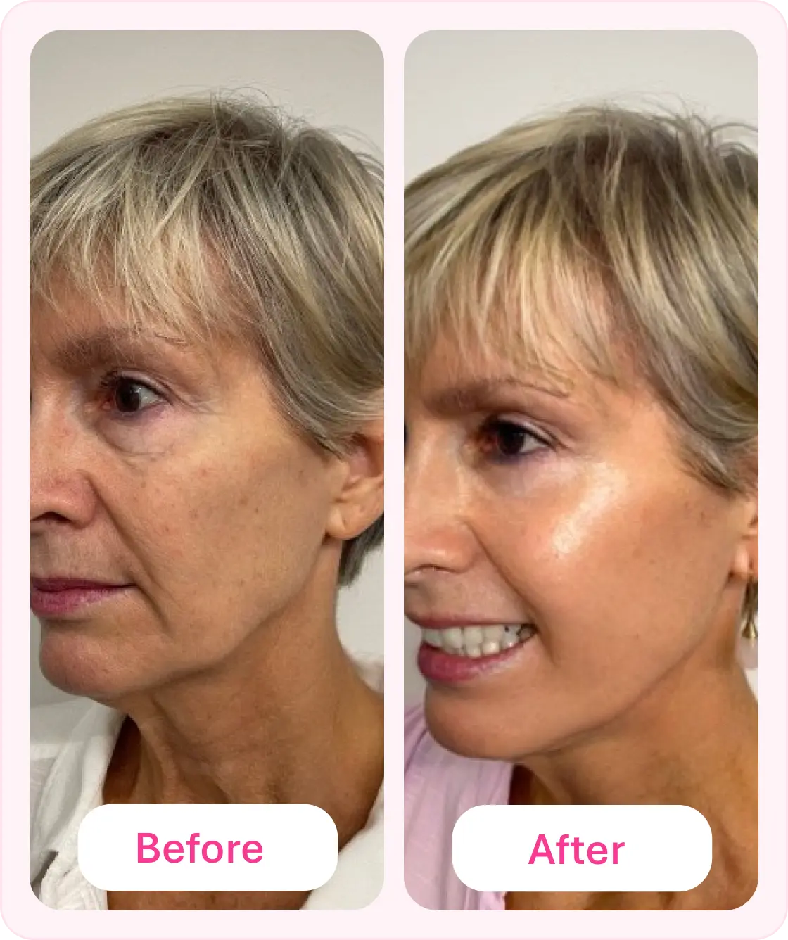 Deep Wrinkles with Retinaldihyde