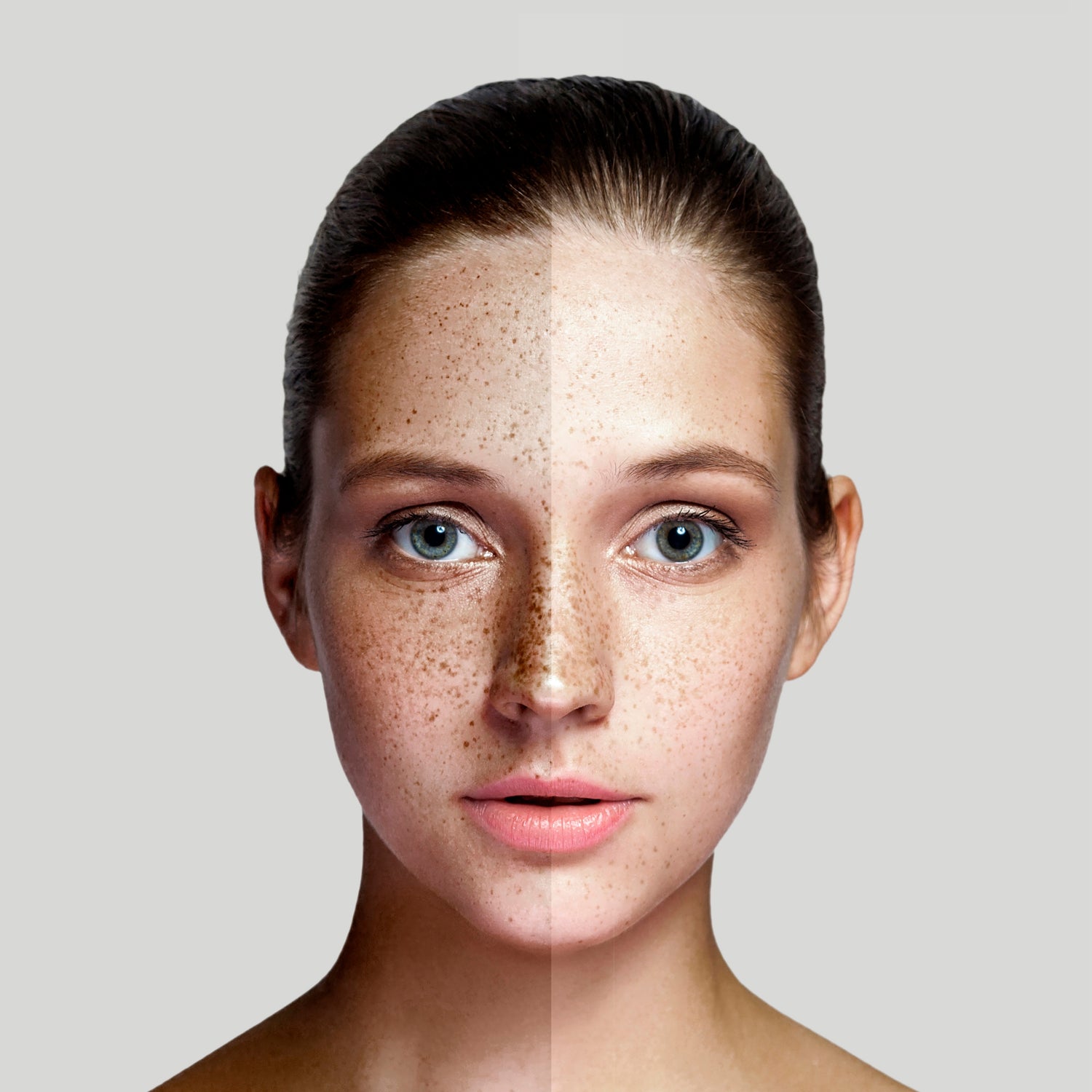 A split-screen, before-and-after portrait of a woman's face, demonstrating the reduction of hyperpigmentation and freckles. The left side shows skin with visible dark spots and uneven tone, while the right side shows a clearer, more even complexion.